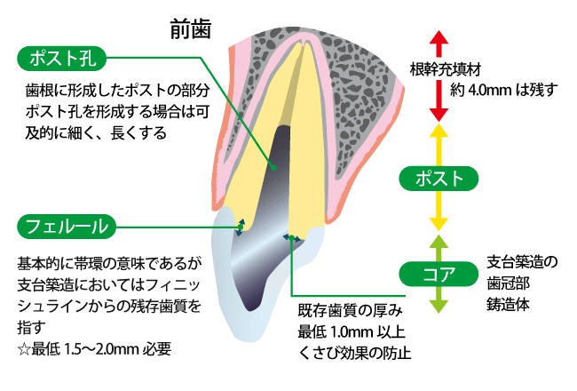 TEK、TeCとプロビジョナルレストレーションとは【歯科用語コラム】 | Doctorbook