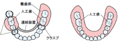 歯冠の被せ物の種類ってどんなものがある？徹底解説！