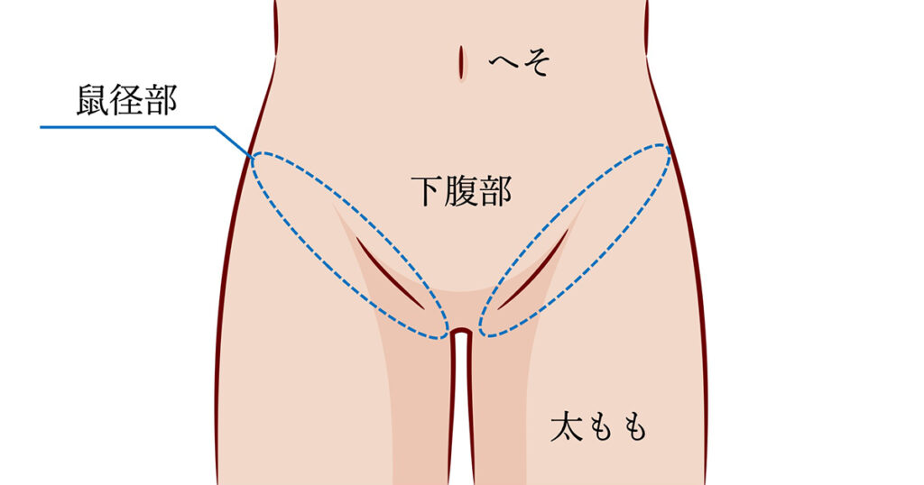 鼠径部痛症候群（グロインペイン症候群） ｜SPORTS MEDICINE LIBRARY｜ザムスト（ZAMST）