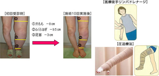 リンパドレナージュとは？ | むくみ専門サロン
