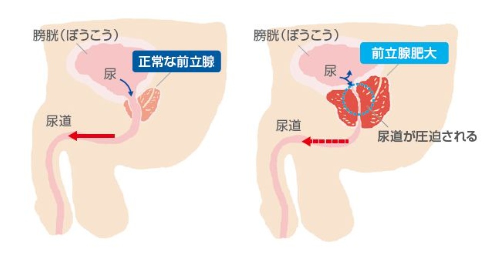 逆行性射精】射精後の尿が白く濁っていたら要注意｜日刊ゲンダイDIGITAL