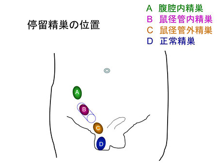 避妊に失敗したときの対処法｜アフターピルはどうすれば手に入る？｜スマルナ