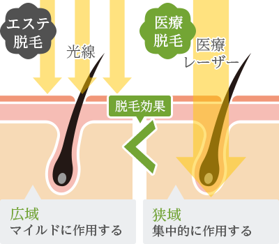 脱毛の種類】効果の違いやメリット・デメリットを比較して解説 - 【東京4院・大阪3院】美容皮膚科フェミークリニック