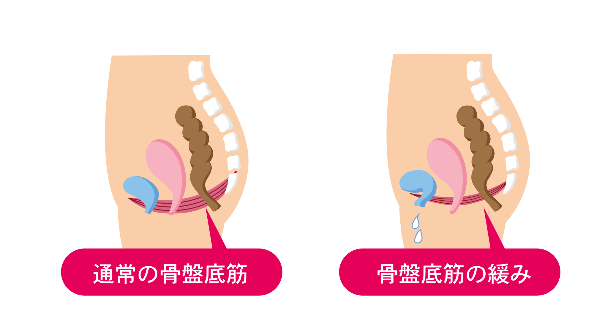 Iラインのムダ毛の処理における基礎知識 ｜形や体勢などの処理方法まで画像付きで紹介 | ReFa（リファ）公式通販