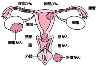 子宮体がん | 当院のがん診療