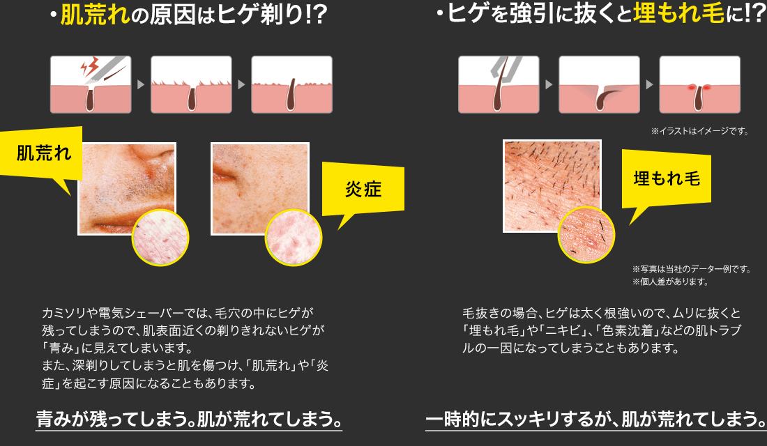 あご髭を抜くのが楽しい！髭抜きに潜む注意点や正しい自己処理方法を解説