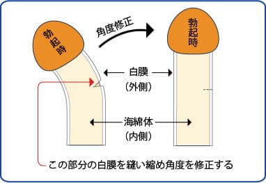 マイクロペニス（小陰茎症）とは？サイズの基準や治療方法を解説【医師監修】 | 新橋ファーストクリニック【公式】