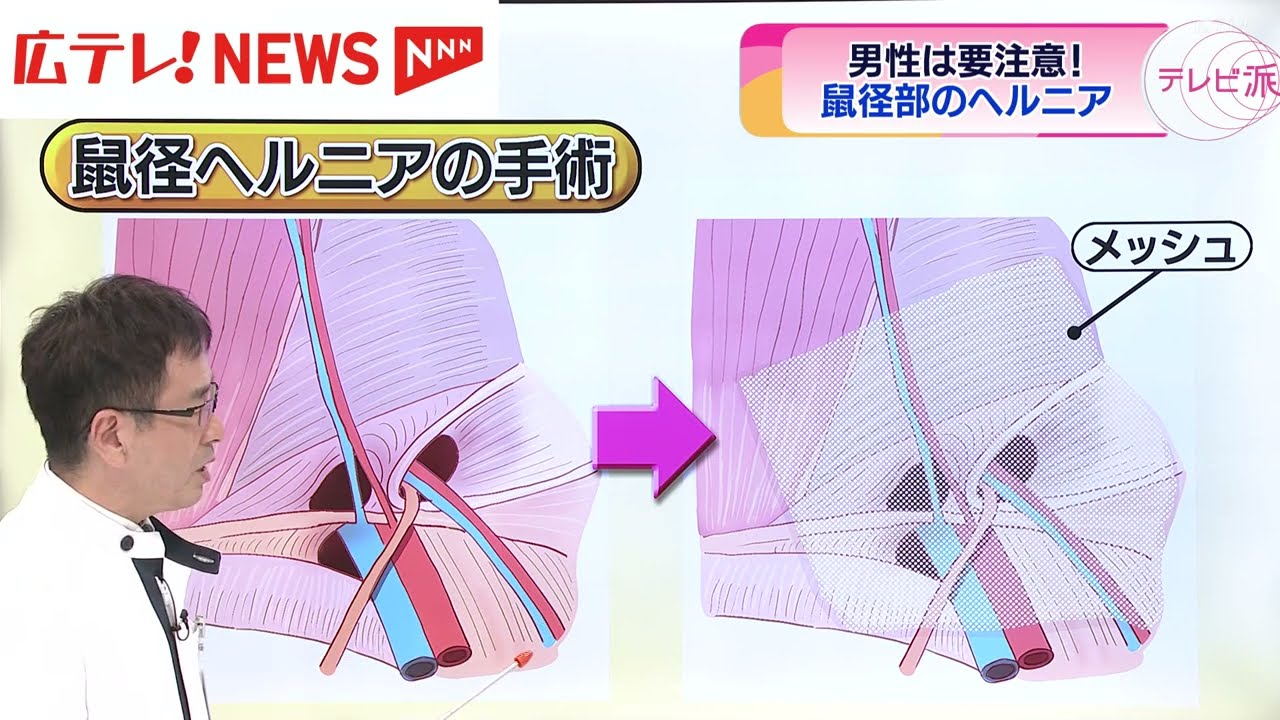 2024年】広島県の鼠径ヘルニア(脱腸)治療 おすすめしたい4医院 |