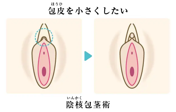 皮を剥くってどこまで？」男児のむく・むかない問題の曖昧さ【医師に聞く】｜CHANTO WEB