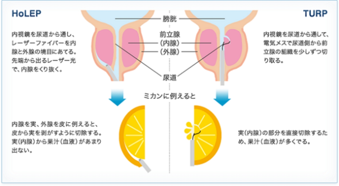 前立腺ステント - EXIME -