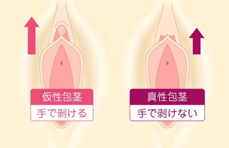 Gスポットの開発方法とGショット(ヒアルロン酸注射で感度アップ)の効果を紹介 | 腟ペディア（チツペディア）