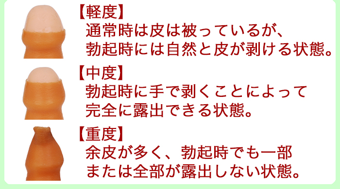 仮性包茎｜包茎の手術や治療は認定専門医に！[東京・大阪]