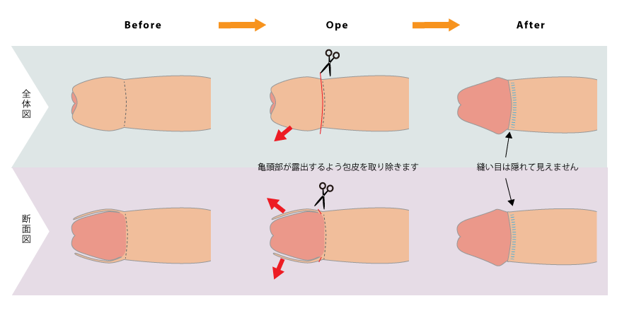 自宅で簡単】包茎矯正グッズの選び方やクリニックとの比較などを解説 | ザヘルプM