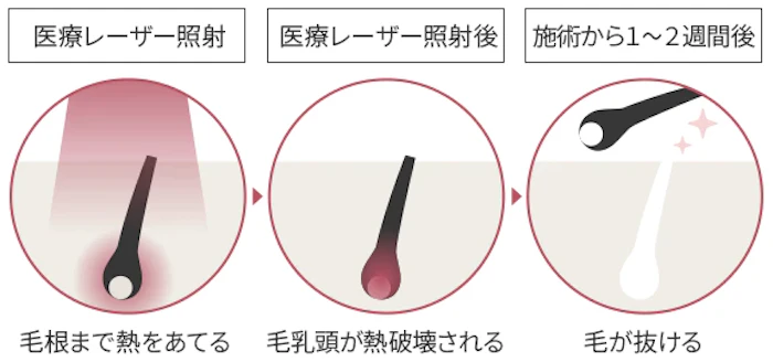 メンズ脱毛はどこまですべき？人気の部位とどこまですべきか悩む人の対処法 - be