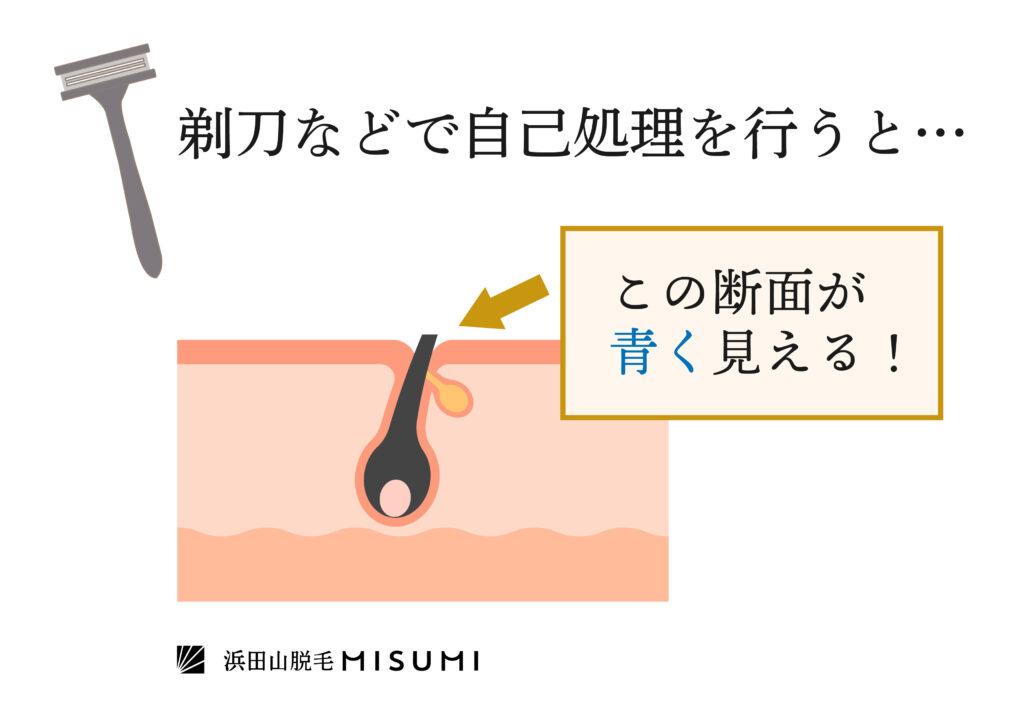 髭は「抜く」よりも「剃る」方が良い！刺激を抑えながらツルツル肌に | ヒゲサポ