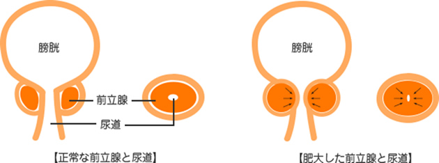 尿がでにくい・尿の勢いが弱い（排尿困難） | みうら泌尿器科クリニック