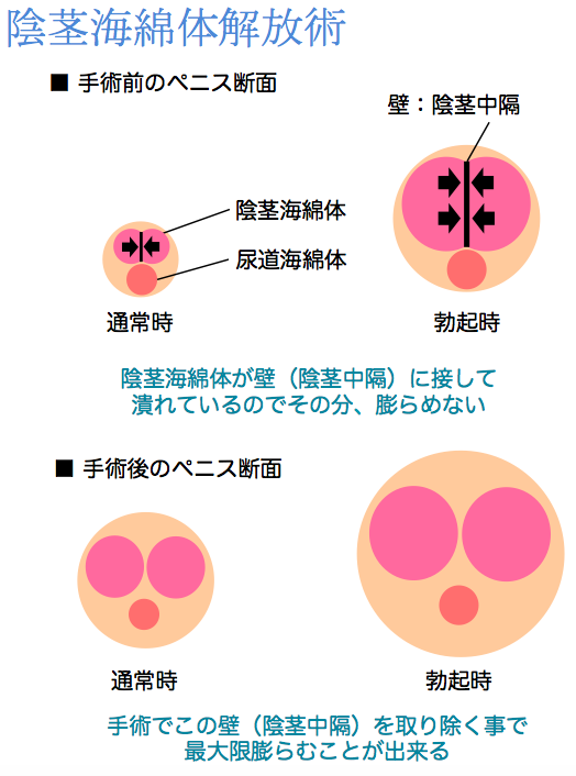 現役医師が解説】AV男優しみけんのチントレって効果あるの？ – メンズ形成外科 |