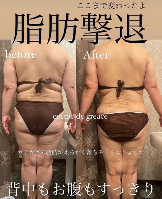 Before&After】背中もお腹もすっきり｜福岡・鹿児島県姶良市のコスメ・デ・グレース グレースフル｜福岡・鹿児島・姶良市の痩身エステ