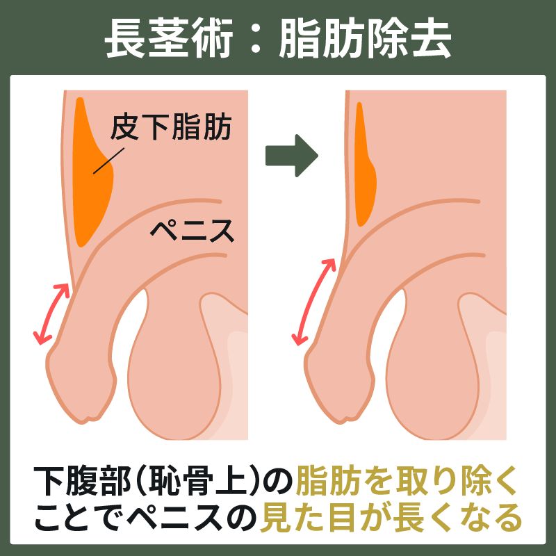 露茎を考察する ～大きさもね編～ | 西新宿杉江中央クリニック