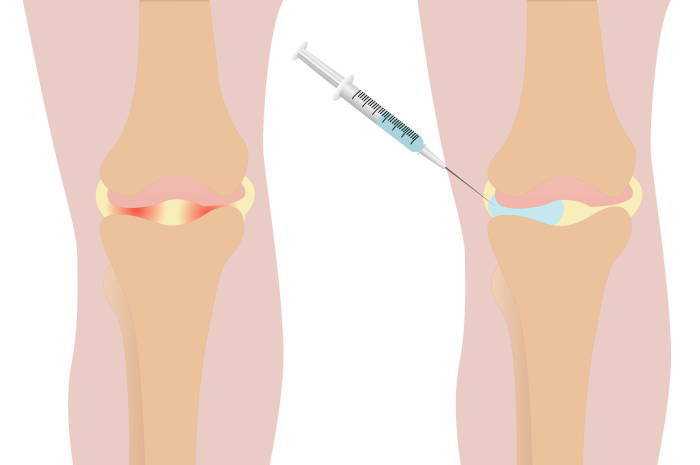 膝サポーターは変形性膝関節症に効果的？【効果・選び方・デメリット】│ひざ関節症クリニック