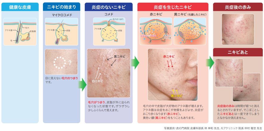 水虫・爪水虫とは(症状、治療、薬など) | 新宿駅前クリニック皮膚科