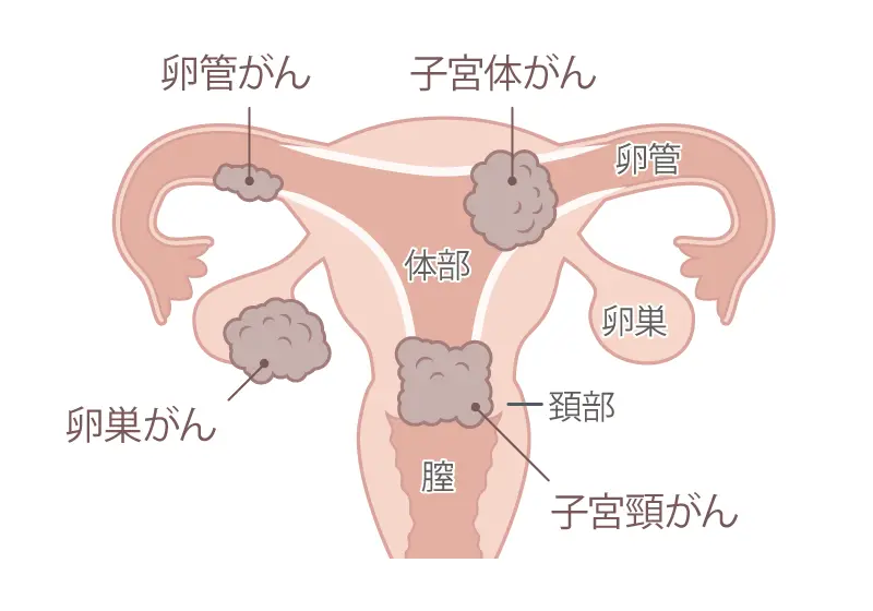 BRCA1/2遺伝子検査について | トリプルネガティブ乳がん | 乳がん.jp