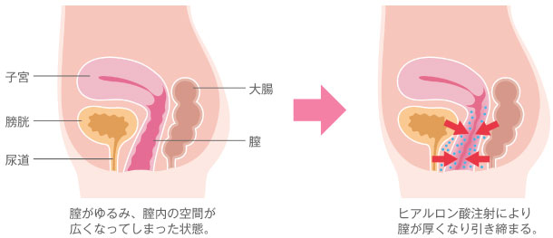 膣縮小術(ヒアルロン酸注入)