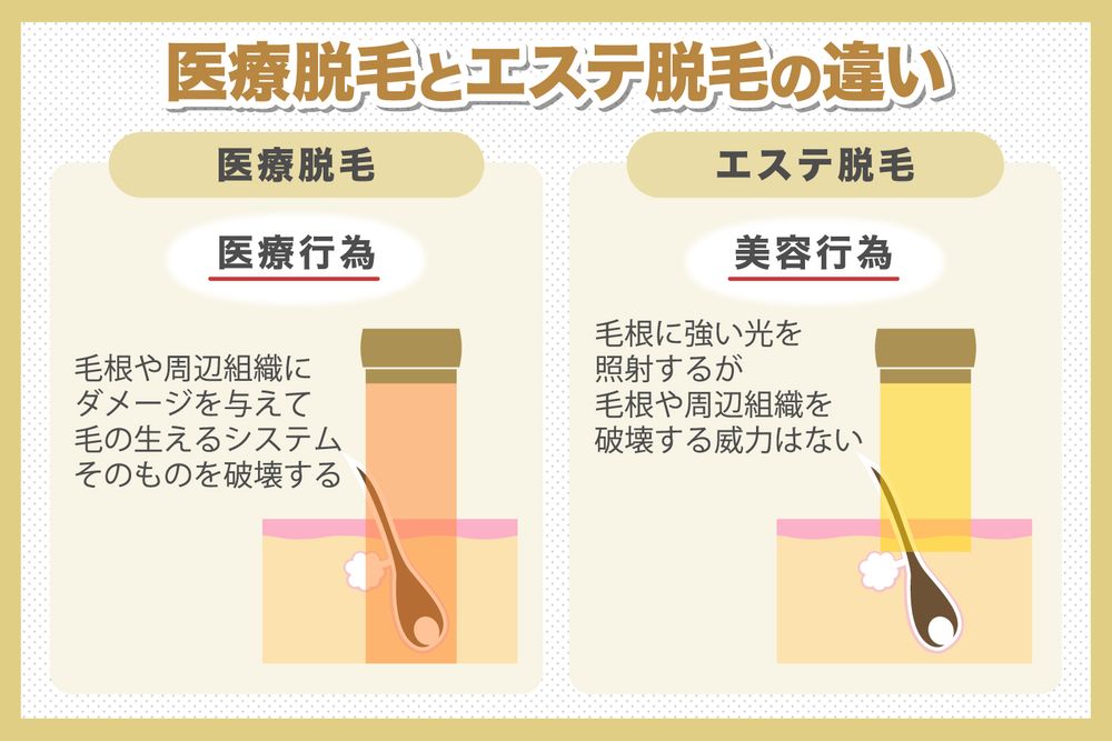 VIO脱毛はするべき？メリット、デメリットと施術のポイントを解説｜脱毛・ダイエットなら美容ナビ｜アイメッド