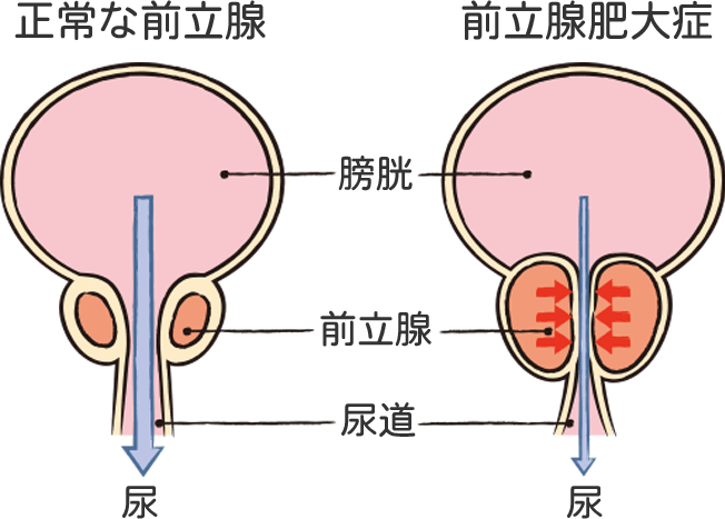 血精液症｜神戸市東灘区の「いしむら腎泌尿器科クリニック」