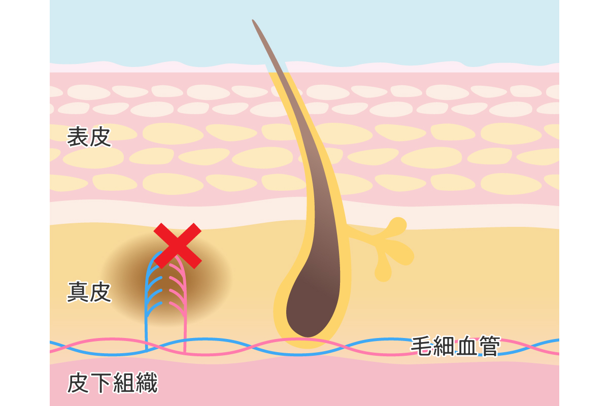 キスマークの隠し方は？ コンシーラーなど簡単に隠す方法｜「マイナビウーマン」