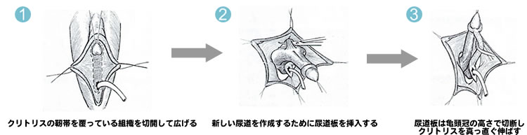 トランスジェンダーが性別適合手術をうけたあと、性感染症検査はどうしたらいいの？ ｜ 男性不妊・メンズヘルス診療 プライベートケアクリニック東京