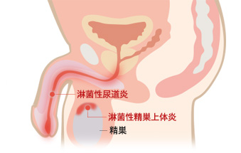 淋菌・クラミジア感染症の現状と問題点｣