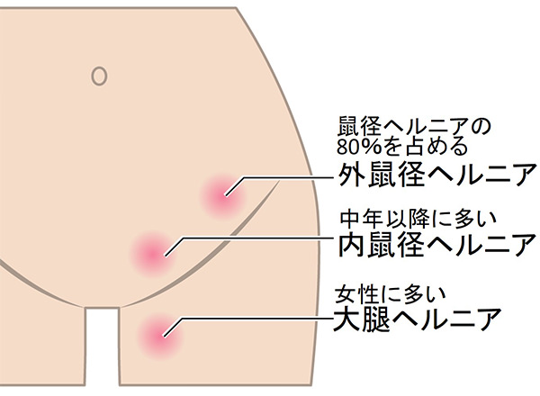 鼠経部リンパを流すって？！】 - リラクゼーション整体サロンふたたびーブログ