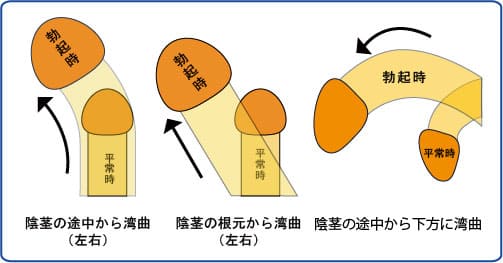 ペニスを大きくする方法は？増大サプリや器具、オナ禁の効果も解説 | 包茎手術のノーストクリニック【公式】