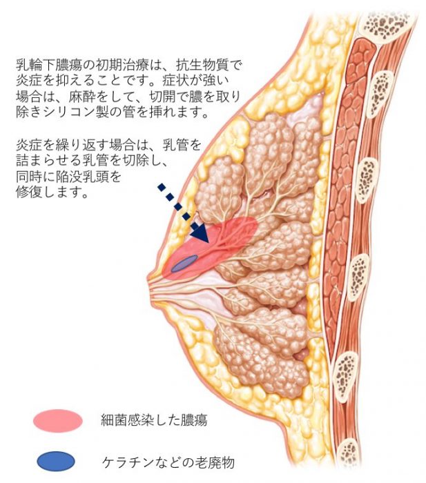 垂れ乳修正（乳房吊上術）の症例写真・画像 | 美容医療の口コミ広場