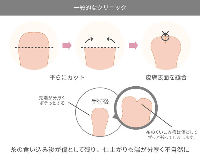 切らない包茎治療 東郷式・ハビット法について」症例写真更新中- | 東郷美容形成外科