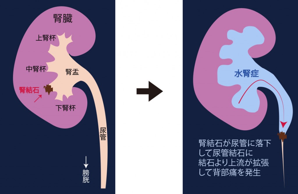 悩ましい「残尿」に秘策はあるか？ | ライフリー