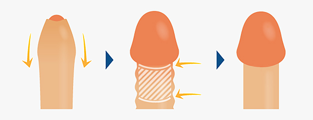 ペニス増大 | HARG(発毛)・AGA・メンズ脱毛・包茎治療ならラミュー・中央クリニック