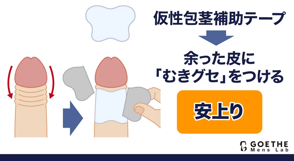 包茎手術法｜包茎治療・包茎手術専門クリニック-東京の銀座みゆき通り美容外科