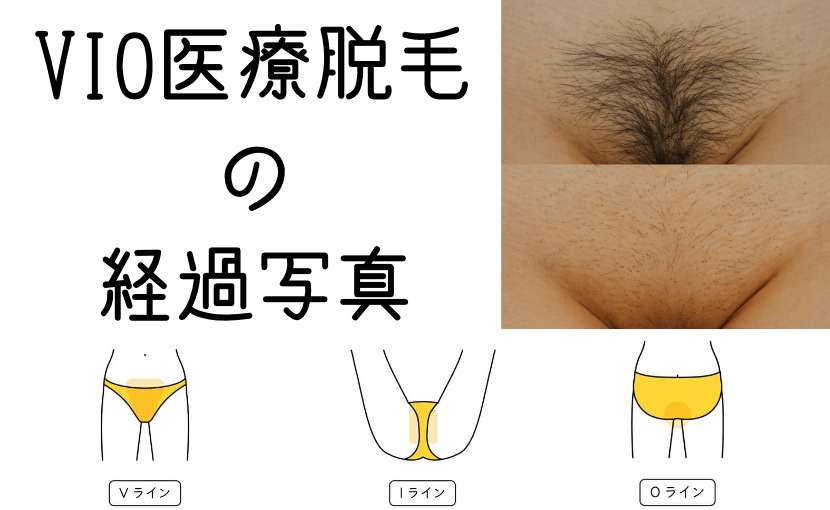 陰毛(アンダーヘア)の白髪の原因と解消方法 | BeautyNavi