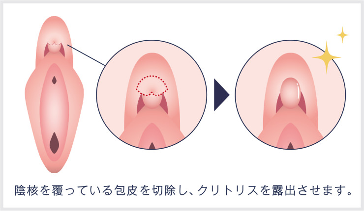 クリトリス（陰核）包茎手術 最安値230,000円 安い！上手い！ 東京