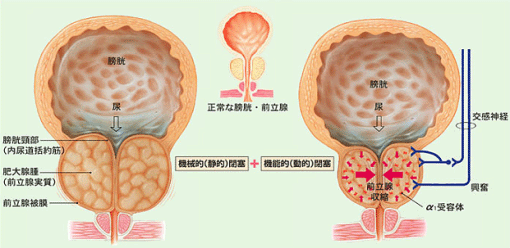 前立腺の病気 - ふじもと医院