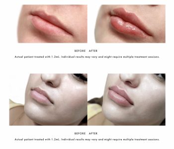 Stylage Lips PLUS